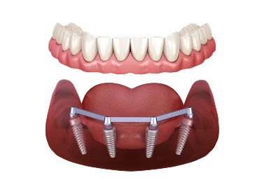 All-on-4 Implants