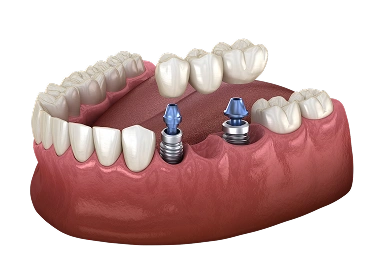 Implants and Bridges