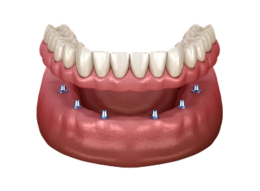 Snap-In Implant Dentures