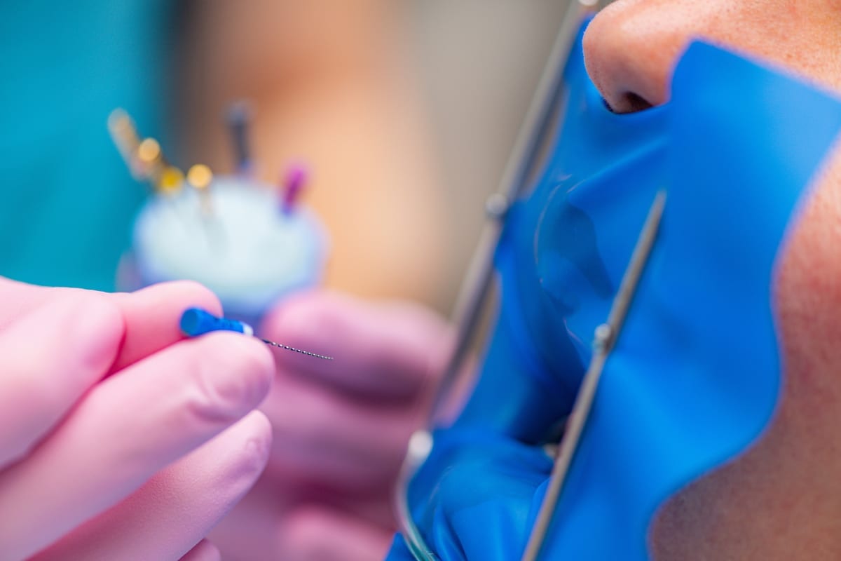 Root Canal Treatment in O'Fallon